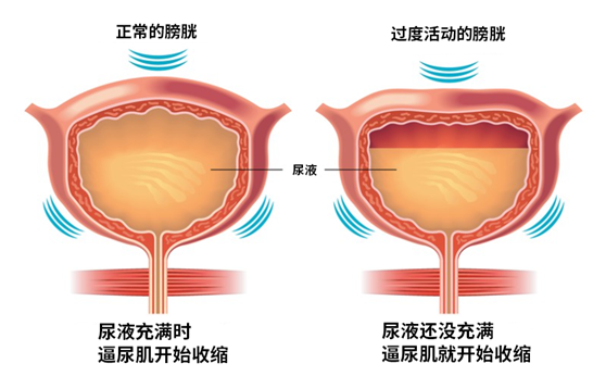 膀胱過度活動(dòng)癥(OAB)示意圖